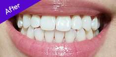 White Teeth