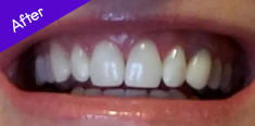 Teeth After Using Burst ToothBrush