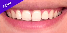 Teeth After Using Burst ToothBrush