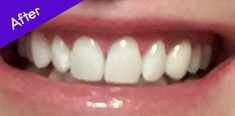 White Teeth After using Electric Toothbrush