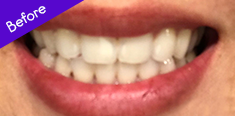 Teeth Before Using Toothbrush