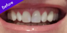 Teeth Before Using Burst ToothBrush