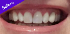 Teeth Before Using BURST Electric Toothbrush